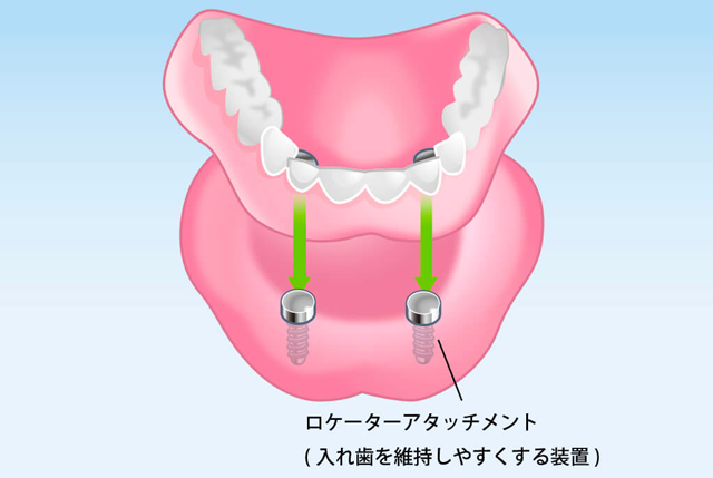 オーバーデンチャー